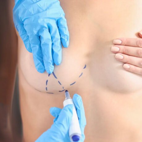 mastopexia-sin-implantes