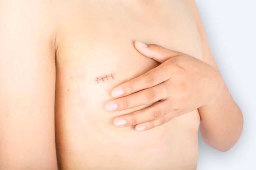 Reconstrucción del tonco