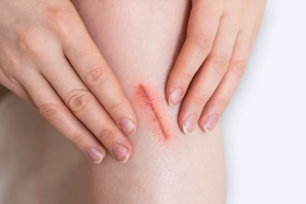 cicatrizacion-tisular-piel