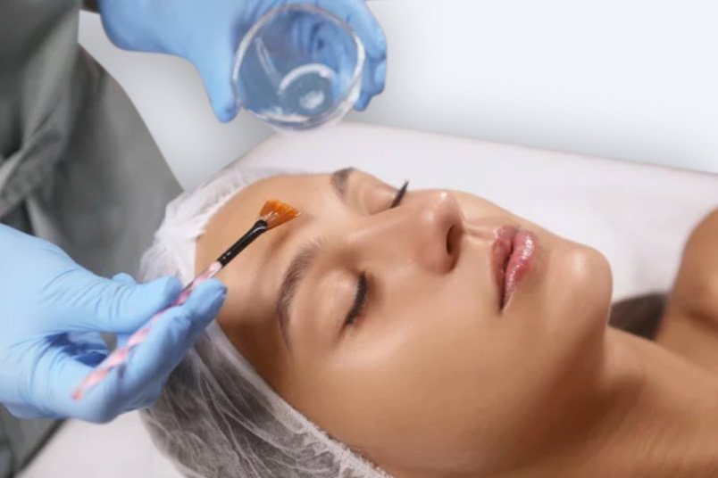 peeling-químico-facial-santander-valladolid