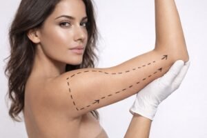 Lipoescultura de brazos: ¿qué es y cómo se realiza?