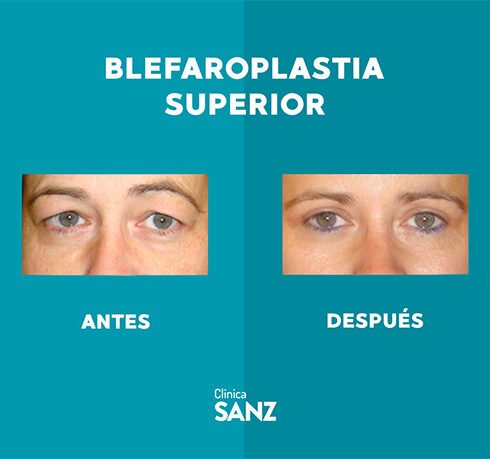 Casos Web Blefaro_0