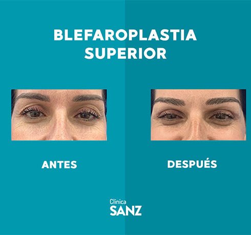 Casos Web Blefaro_0