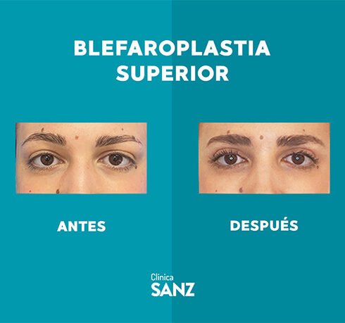 Casos Web Blefaro_0