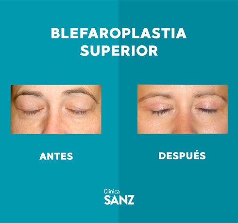 Casos Web Blefaro_1