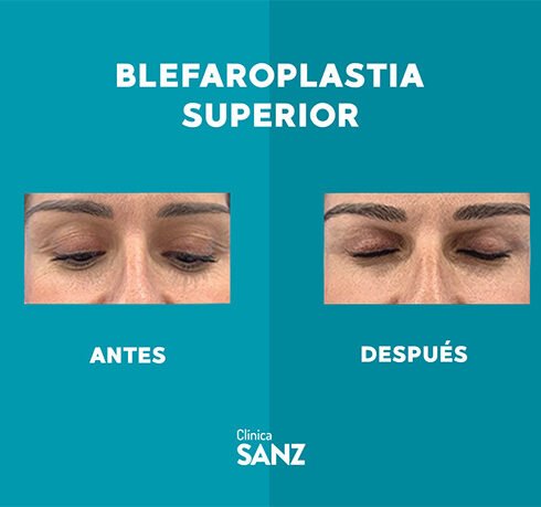 Casos Web Blefaro_1