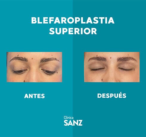 Casos Web Blefaro_1